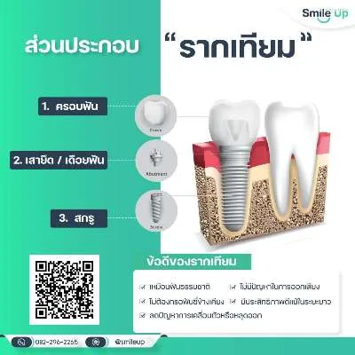 รากฟันเทียม